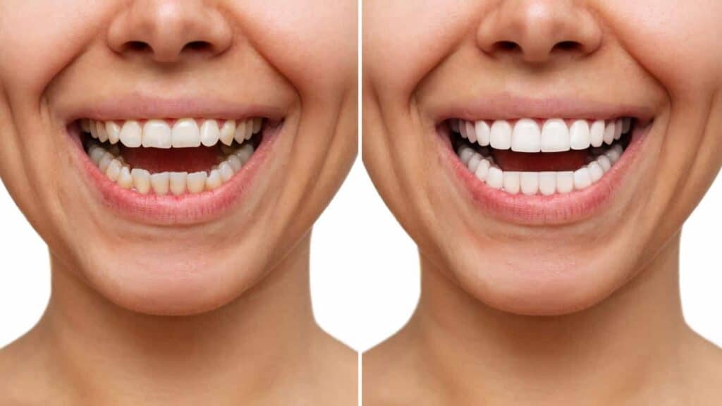 Before and after teeth whitening results. Ipswich