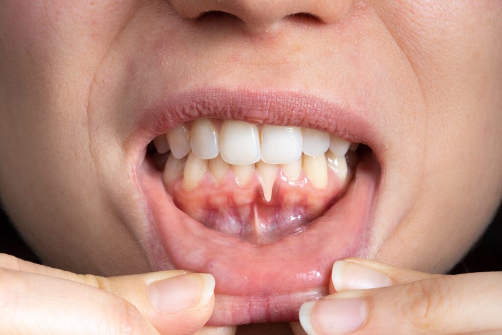 Preparing for teeth whitening with receding gums Ipswich